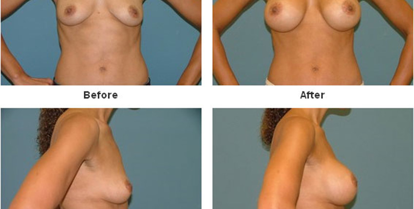 breast-augmentation-292-850x430